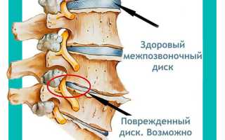 Симптомы, причины и методы лечения защемления нерва в позвоночнике