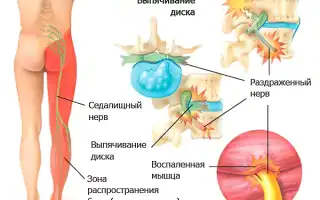 Проблемы с защемлением нерва в спинном столбе: причины, симптомы, диагностика и методы лечения