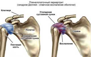 Почему возникают боли в плече при поднятии руки вверх и как с ними бороться: основные причины и эффективные методы лечения