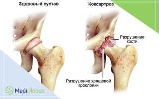 Как лечить коксартроз 4 степени без операции: натуральные методы и препараты