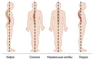 Как определить кривизну позвоночника по фотографиям: виды и симптомы