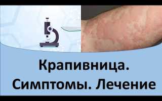 Острая крапивница: симптомы, причины и эффективное лечение в прошлом и настоящем