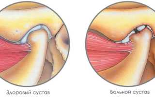 Почему возникает щелканье челюсти и как с ним бороться: причины и полезные советы