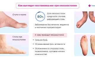 Плоскостопие: причины, симптомы и возможные последствия