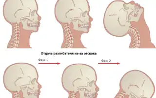 Причины, симптомы и методы лечения боли в шее при повороте головы