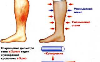 Лимфостаз нижних конечностей
