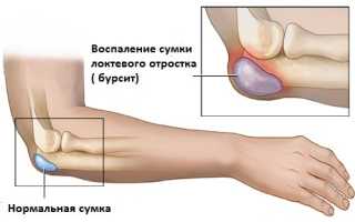 Лечение бурсита локтевого сустава: основные методы терапии и способы избавления от него