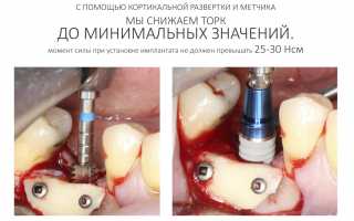 Цель и особенности процедуры остеотомии: освоение базовых принципов и специфика процедуры.