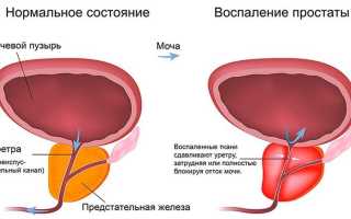 Содовые методы лечения простатита – их эффективность и способы применения