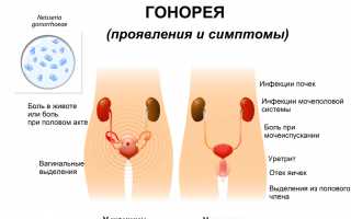 Фото симптомов и методы лечения гонореи горла – новости из мира науки