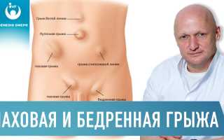 Бедренная грыжа: причины, симптомы, методы диагностики и эффективные способы лечения