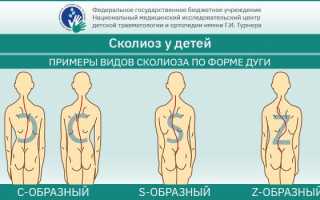 Причины, диагностика и методы лечения сколиоза у подростков