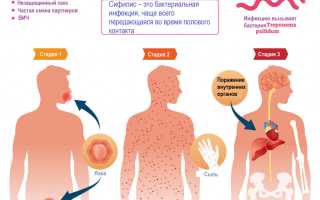 Лечение и диагностика симптомов второй стадии сифилиса