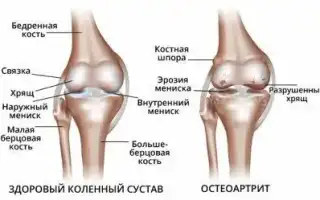 Диагностика и лечение боли в передней части колена: основные причины и современные методы терапии