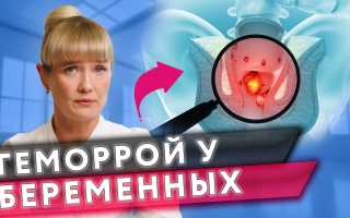 7 полезных советов о том, как предотвратить геморрой во время родов