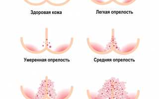 Что может стать причиной красной попы у ребенка и как ее можно вылечить
