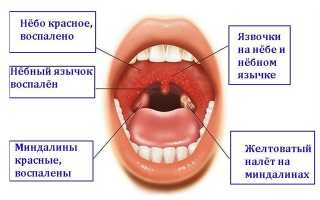 Причины, симптомы и методы лечения герпеса в горле