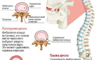 Возможности диагностики и причины грыжи позвоночника: признаки, лечение