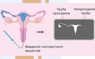 Методы и рекомендации по зачатию после гистеросальпингографии
