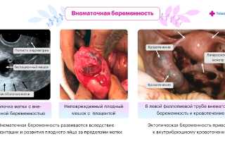 Диагностика и возможные последствия внематочной беременности: можно ли успешно родить ребенка?