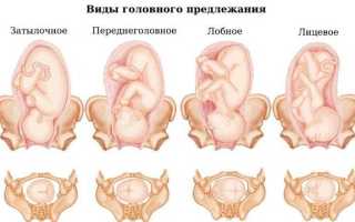 Проблема лицевого предлежания плода – признаки, причины и потенциальные опасности.