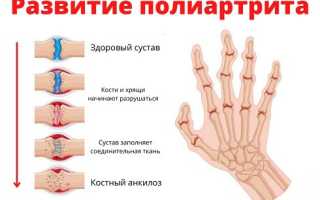 Причины и симптомы полиартрита: основная информация, которую нужно знать