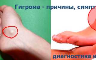 Эффективное лечение гигромы на ноге с помощью народных средств: мнения врачей и пациентов, полезные рецепты трав, способы приготовления отваров и компрессов