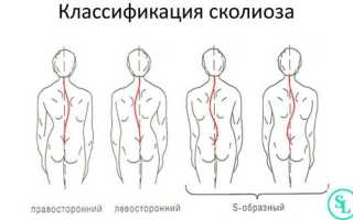 Левосторонний сколиоз: симптомы, причины, методы диагностики и лечения