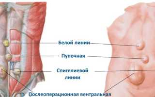 Что вызывает грыжи передней брюшной стенки, какие симптомы они вызывают и как их лечить: полезная информация на сайте.