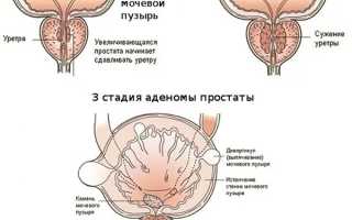 Аденома предстательной железы – стадии развития, симптомы, методы диагностики и лечения
