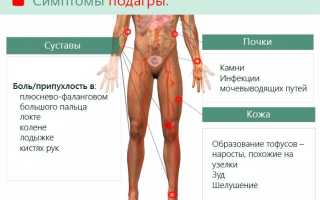 Симптомы, причины и методы лечения подагры: основная информация