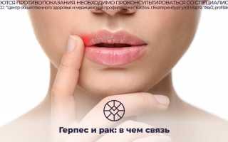 Особенности связи герпеса и рака – риски и взаимосвязь между этими заболеваниями