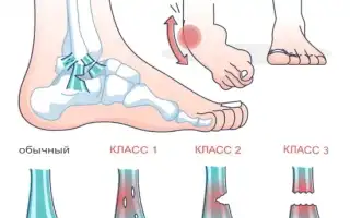 Советы и рекомендации по эффективному лечению растяжения связок коленного сустава