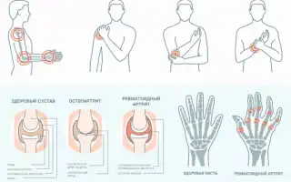 Причины, симптомы и методы лечения артрита у детей