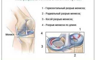 Мениск коленного сустава: функции, причины травмы, методы диагностики и лечения