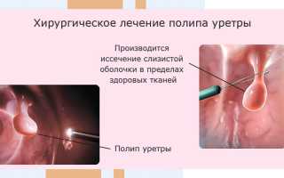 Причины, симптомы и методы лечения полипов уретры в соответствии с Международной классификацией болезней 10-го пересмотра
