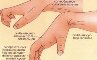 Актуальные рекомендации по определению и лечению симптомов вывиха костей запястья