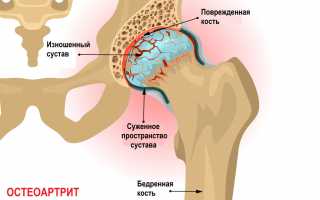 Симптомы, причины, диагностика и лечение трещины в тазобедренном суставе