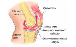 Жидкость в коленном суставе