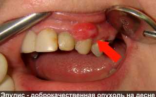 Эпулис: виды, причины, признаки, симптомы и лечение
