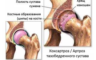 Эффективное консервативное лечение коксартроза тазобедренного сустава 3 степени: избегаем операцию и достигаем положительных результатов.