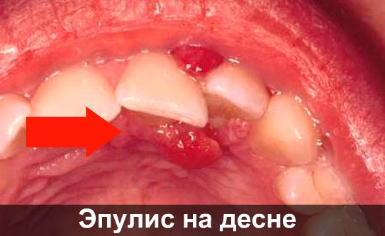 Эпулис на десне