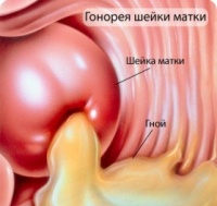 Гонорея шейки матки.