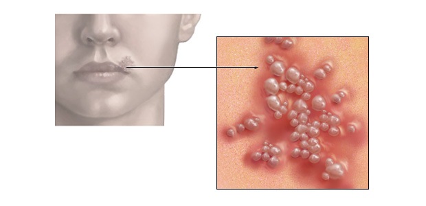 Герпес на лице Герпес на лице