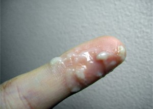 Выделения на пальце Выделения на пальце