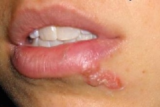 Герпес на губах Герпес на губах