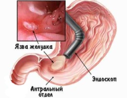 Язва желудка Язва желудка