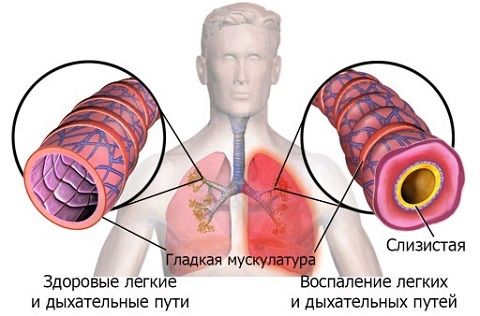 При кашле боль в легких