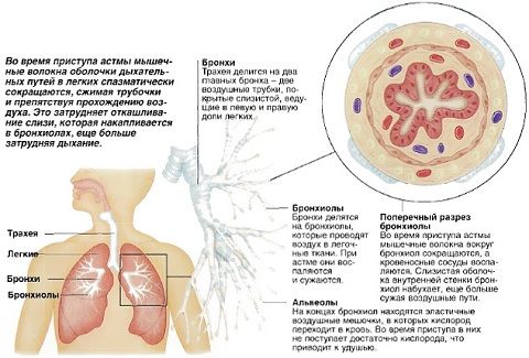 Хрипы в бронхах