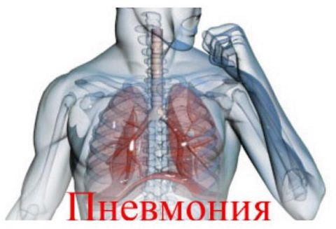 Острая пневмония